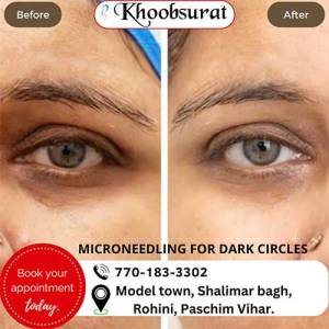 Dark Circles Treatment  in Lajpat Nagar