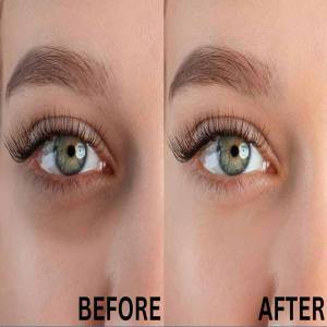 Dark Circles Treatment in Lajpat Nagar