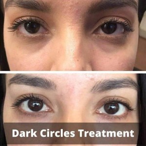 Dark Circles Treatment in Defence Colony