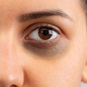 Dark Circles Treatment in Laxmi Nagar