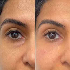 Dark Circles Treatment in Chandni Chowk