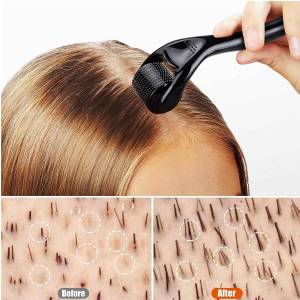 Derma Rollers for Hair Growth and Stop Hair Fall in Model Town