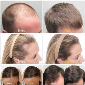 Derma Rollers for Hair Growth and Stop Hair Fall in Model Town