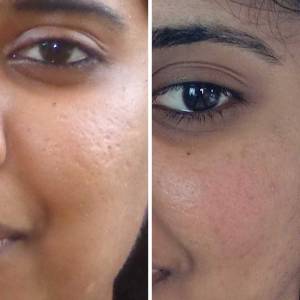 Derma Rollers for Skin Tightening and Enhancement in Mehrauli