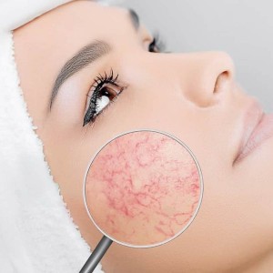 Discoloration Treatment in Ghaziabad