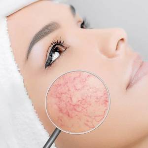 Discoloration Treatment in Sarojini Nagar