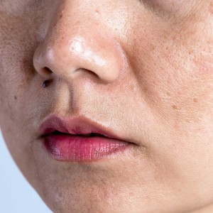 Discoloration Treatment in Nehru Place