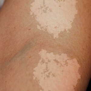 Discoloration Treatment in Noida