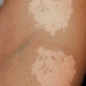 Discoloration Treatment in Nehru Place