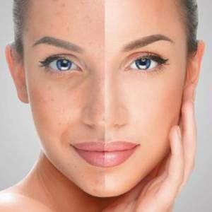 Discoloration Treatment in Vasant Vihar