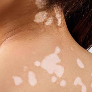 Discoloration Treatment in Vasant Kunj