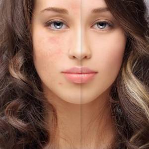 Discoloration Treatment in Kirti Nagar