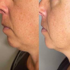 Figure Correction Through Fractional RF in Delhi