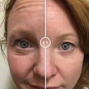 Figure Correction Through Fractional RF in Delhi