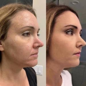 Figure Correction Through Fractional RF in Delhi