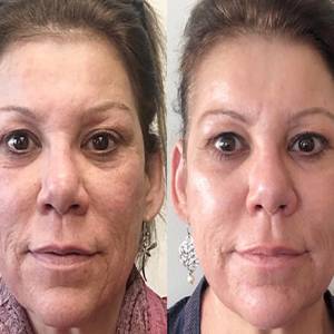 Figure Correction Through Fractional RF in Delhi