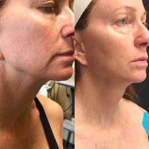 Figure Correction Through Fractional RF in Delhi