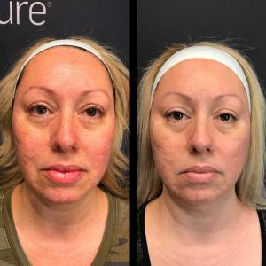 Figure Correction Through Fractional RF in Delhi