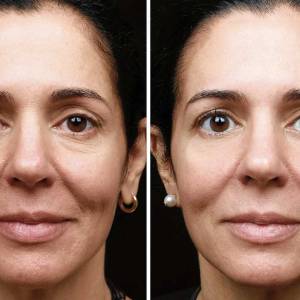 Figure Correction Through Fractional RF in Delhi