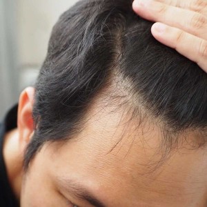 Hair Fall Treatment in Delhi
