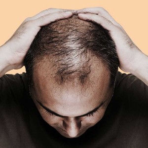 Hair Fall Treatment in Defence Colony