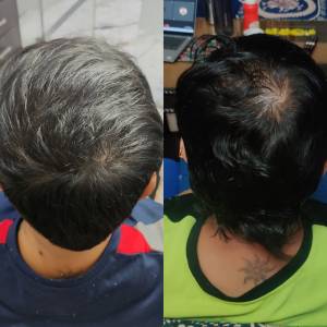 Hair Fall Treatment in Delhi