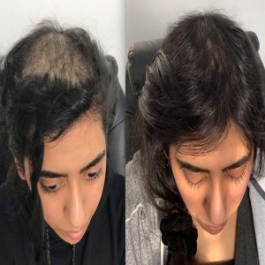 Hair Growth Treatment in Najafgarh