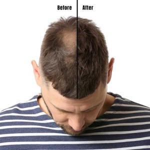 Hair Growth Treatment in Naraina