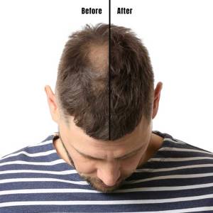 Hair Growth Treatment in Uttar Pradesh