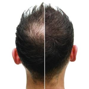 Hair Growth Treatment in Paschim Vihar