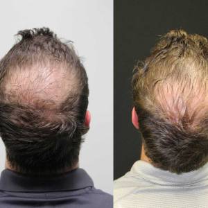 Hair Growth Treatment in Saket