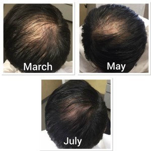 Hair Growth Treatment in Shahdara