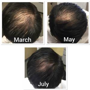 Hair Growth Treatment in Kirti Nagar