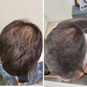 Hair Treatment in Connaught Place