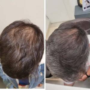 Hair Treatment in Gautam Buddha Nagar