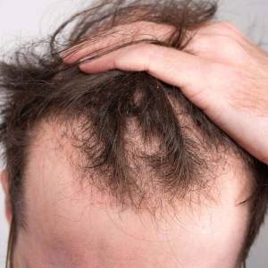 Hair Treatment in Moti Nagar