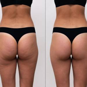 Hip Tuck in Karawal Nagar