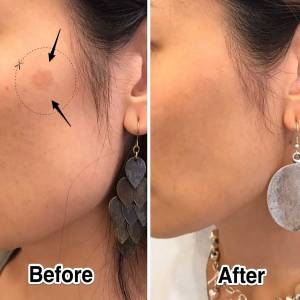 Laser Skin Treatment in Paschim Vihar