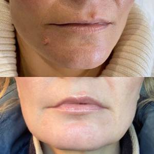 Mole Removal in Delhi