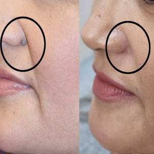 Mole Removal in Delhi