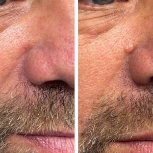Mole Removal in Delhi