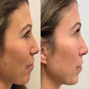 Mole Removal in Delhi