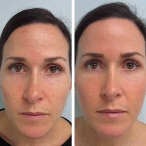 Mole Removal in Delhi