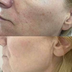 Mole Removal in Delhi