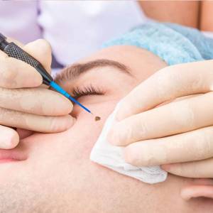 Mole Treatment in Delhi