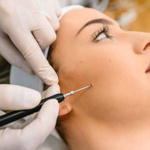 Mole Treatment in Delhi