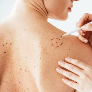 Mole Treatment in Delhi