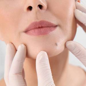 Mole Treatment in Delhi