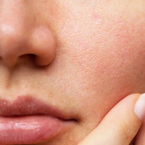 Open Pores Treatment in Civil Lines