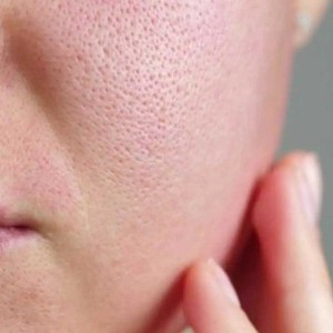 Open Pores Treatment in Yamuna Vihar